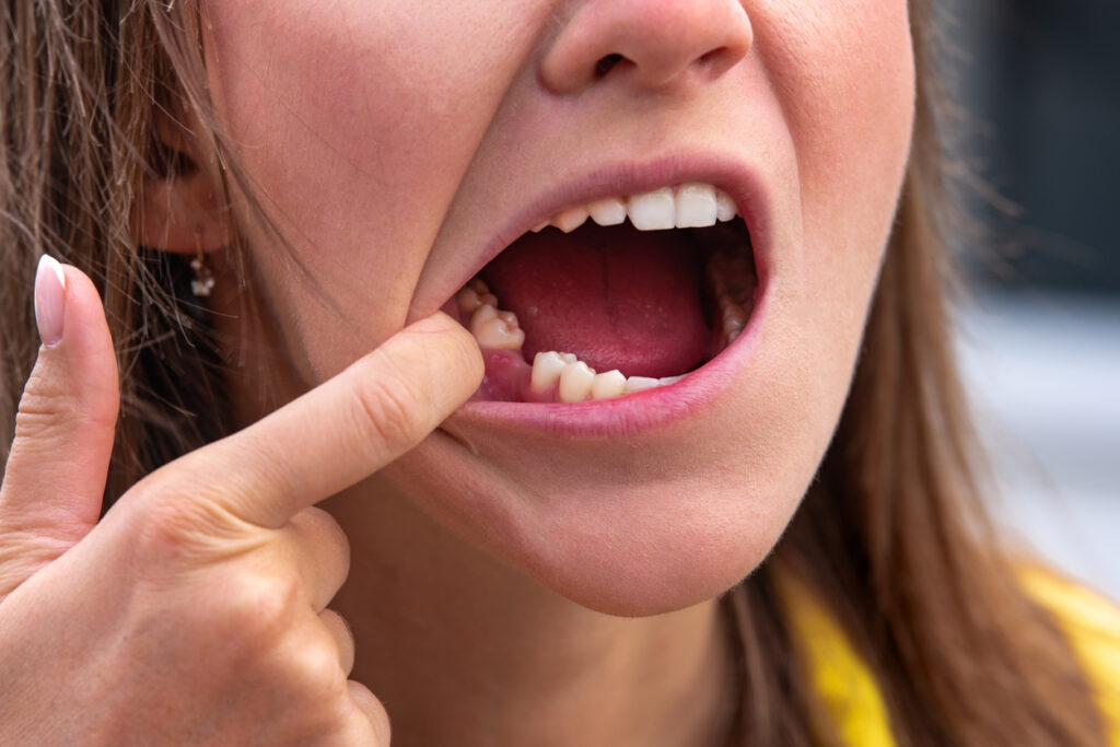 dental patient showing a successful tooth extraction