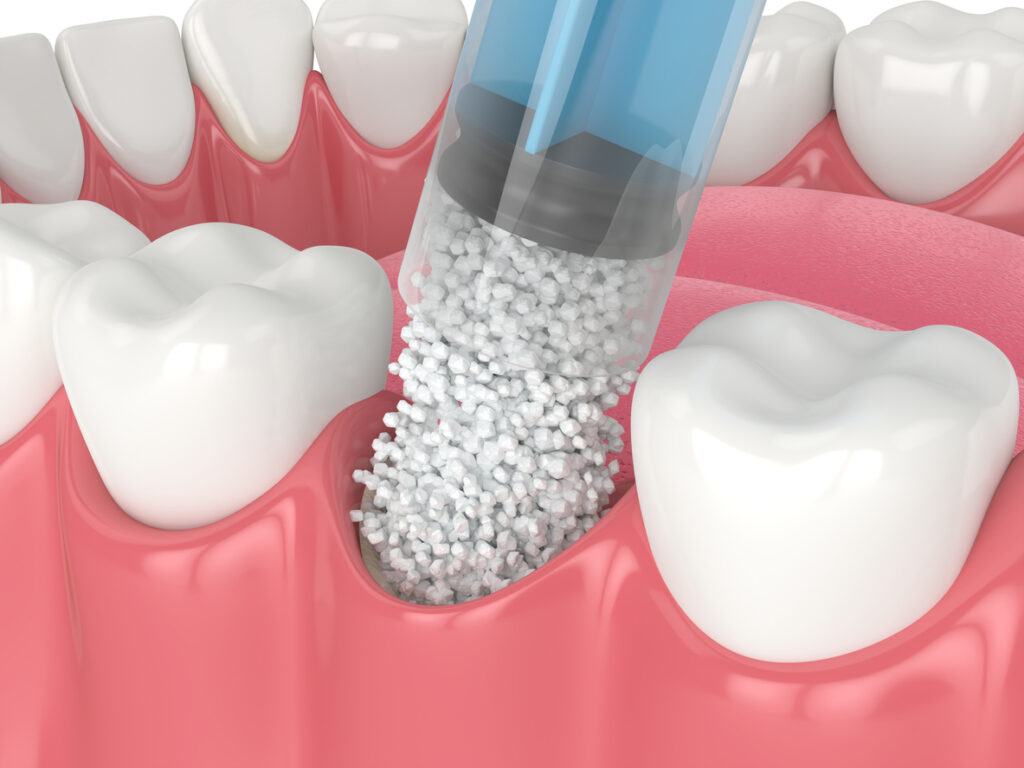 showing bone grafting after the removal of a tooth