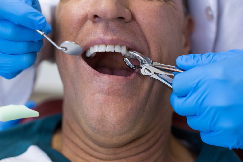 Pateint getting a tooth removed at the dental office with surgical pliers